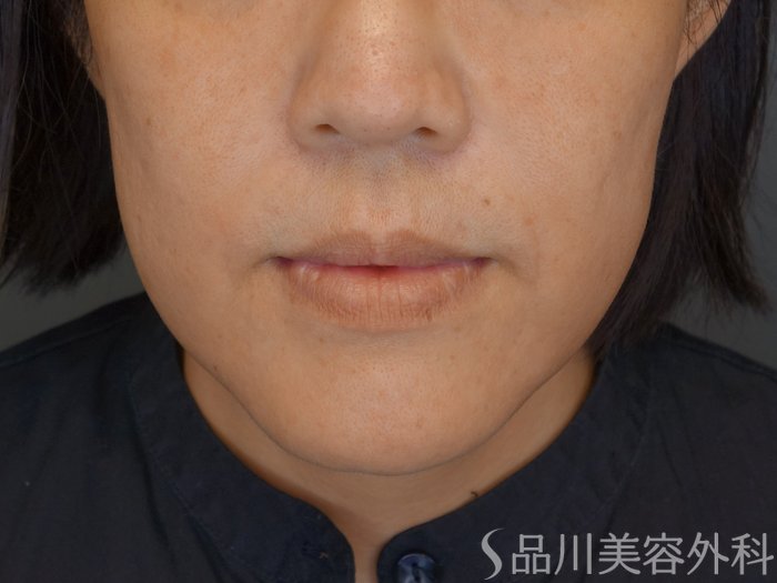 症例NO.71705のBEFORE写真
