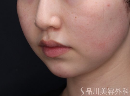 症例NO.71825のBEFORE写真