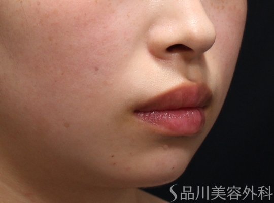 症例NO.73399のAFTER写真