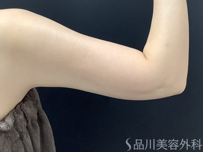 症例NO.75366のAFTER写真