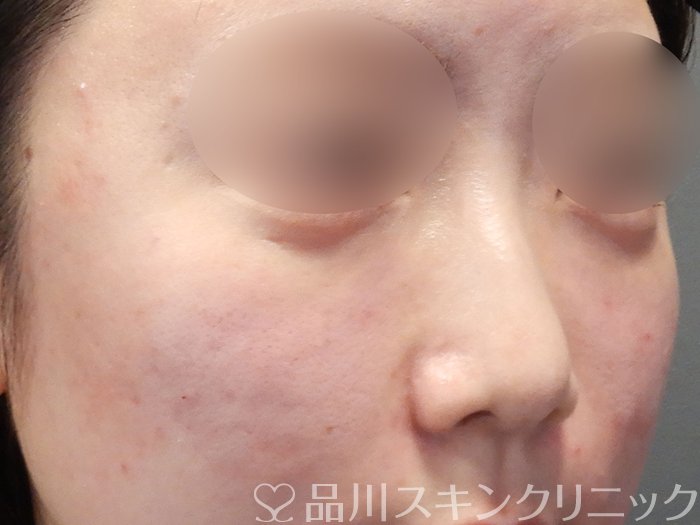 症例NO.72695のAFTER写真