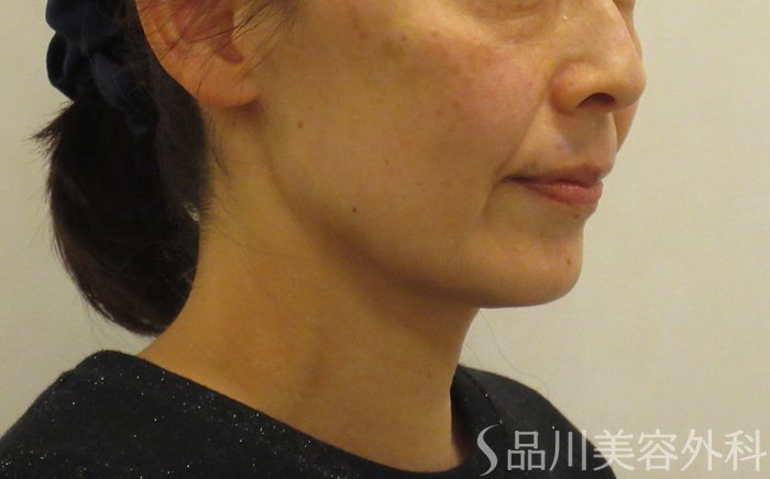 症例NO.72870のAFTER写真