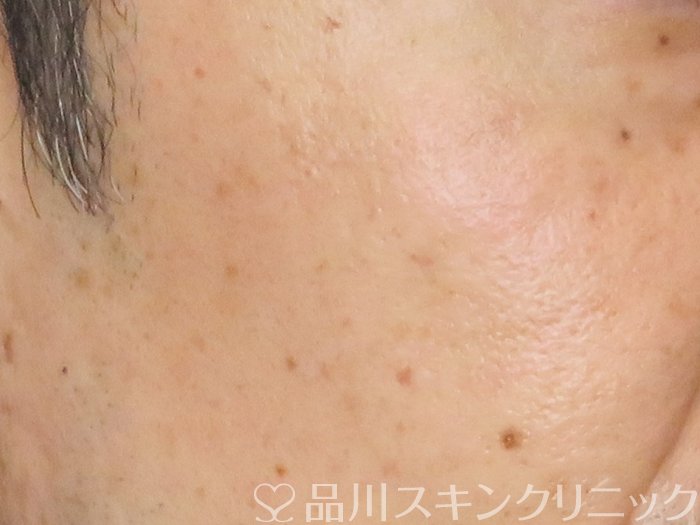 症例NO.65454のAFTER写真