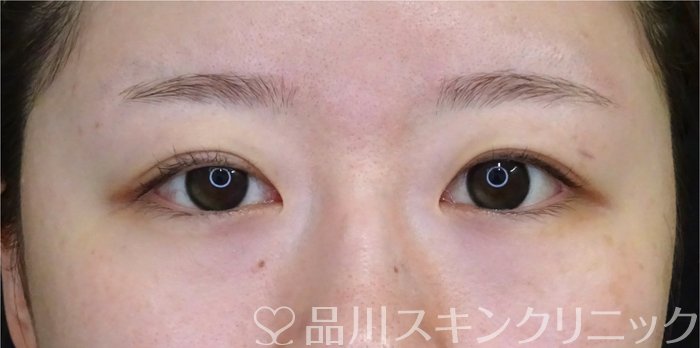 症例NO.69790のAFTER写真