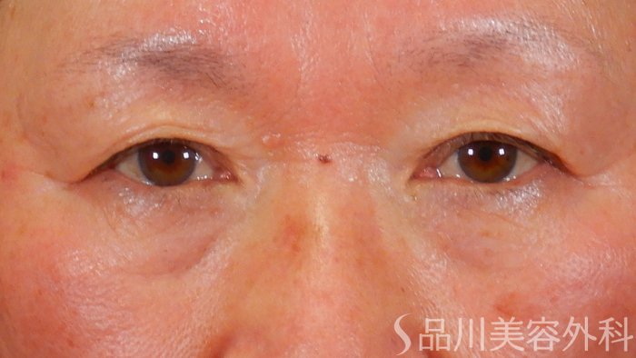 症例NO.69584のBEFORE写真