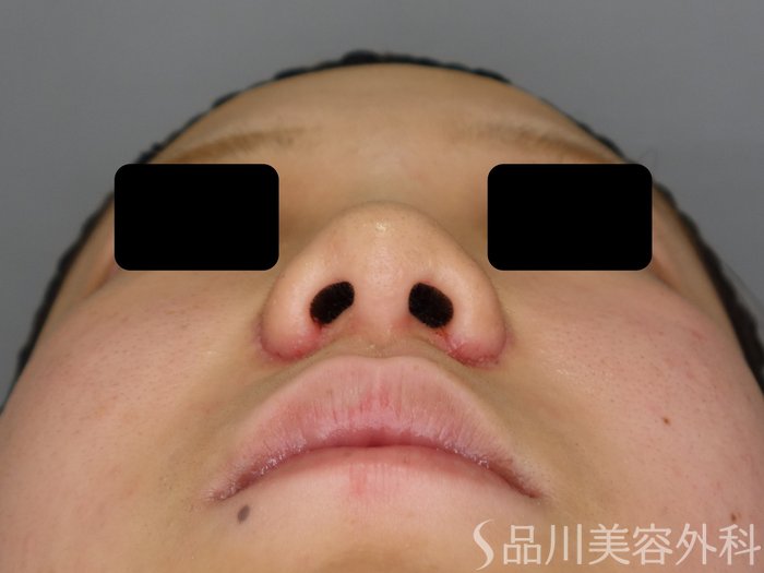 症例NO.74871のAFTER写真
