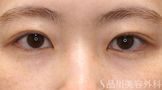 症例NO.74368のAFTER写真