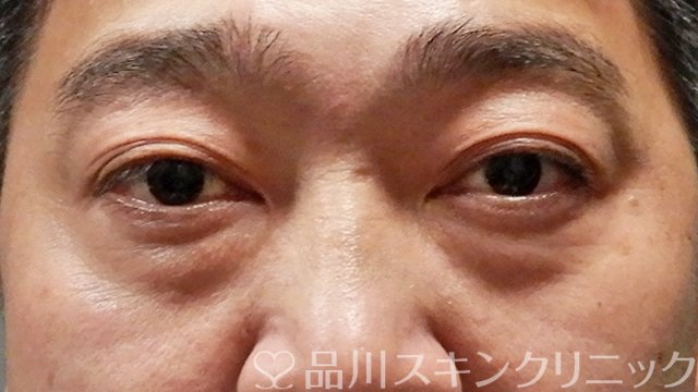 症例NO.64614のBEFORE写真