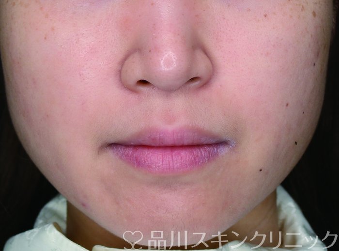 症例NO.74174のAFTER写真