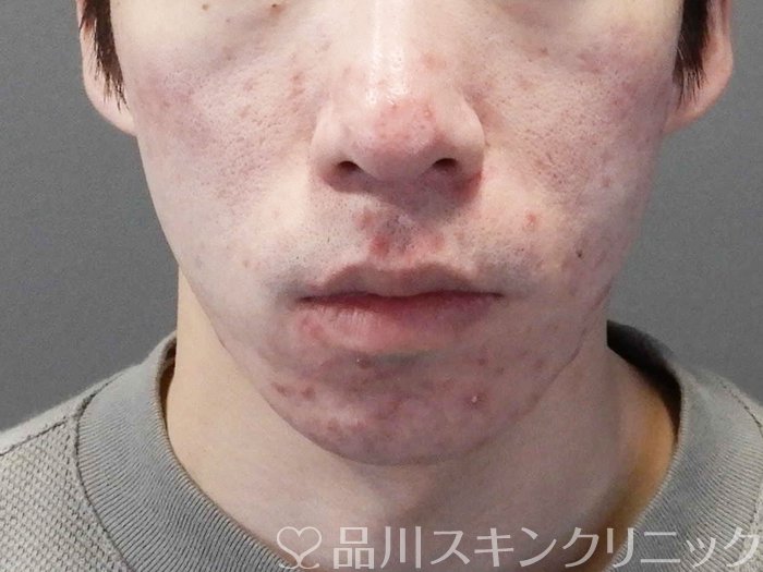 症例NO.69645のBEFORE写真