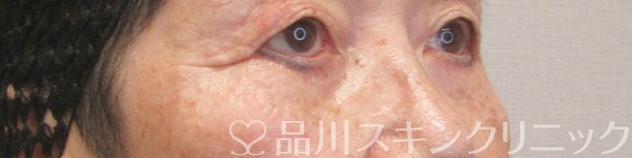症例NO.75343のAFTER写真