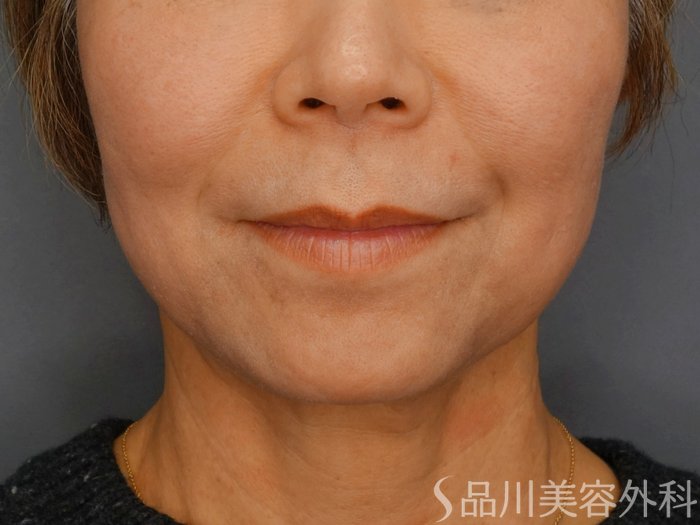 症例NO.72749のBEFORE写真