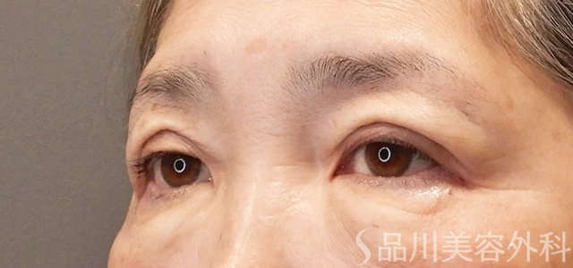 症例NO.72485のAFTER写真