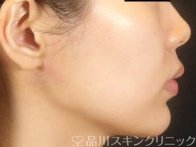 症例NO.74305のAFTER写真
