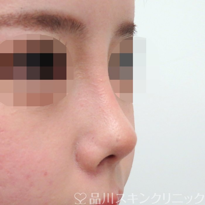 症例NO.71290のAFTER写真