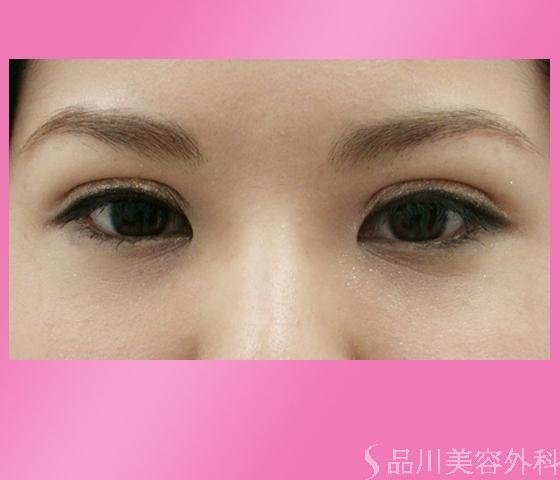 症例NO.1169のAFTER写真