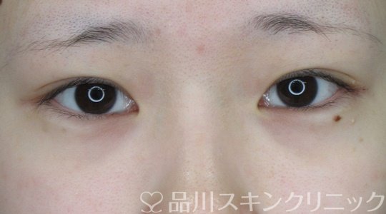 症例NO.69990のAFTER写真