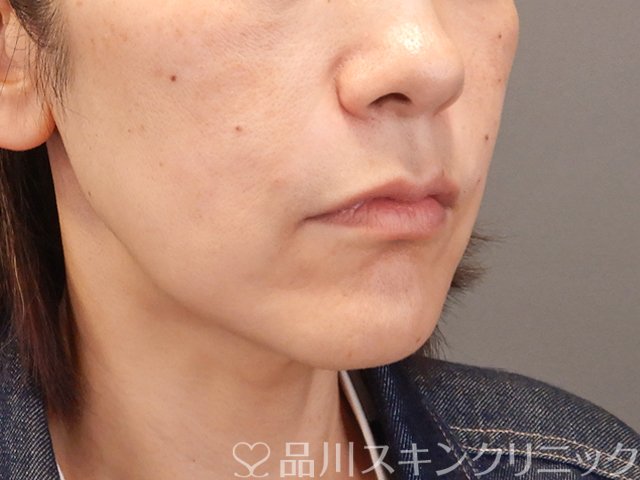 症例NO.75087のAFTER写真