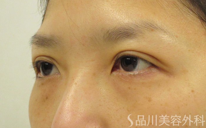 症例NO.62609のAFTER写真