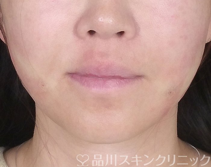 症例NO.69374のAFTER写真