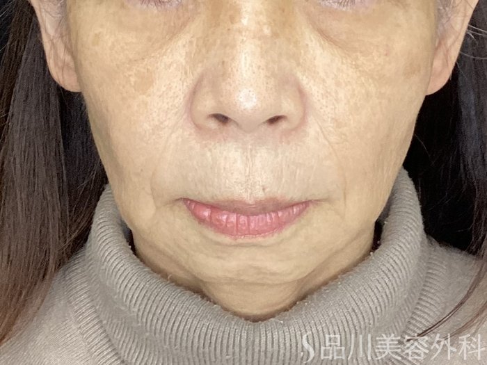 症例NO.72092のBEFORE写真