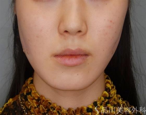 症例NO.51056のAFTER写真