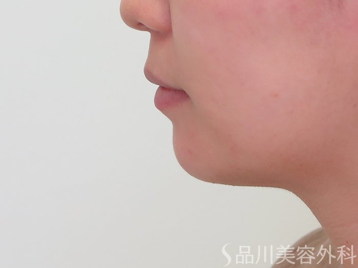 症例NO.69716のBEFORE写真