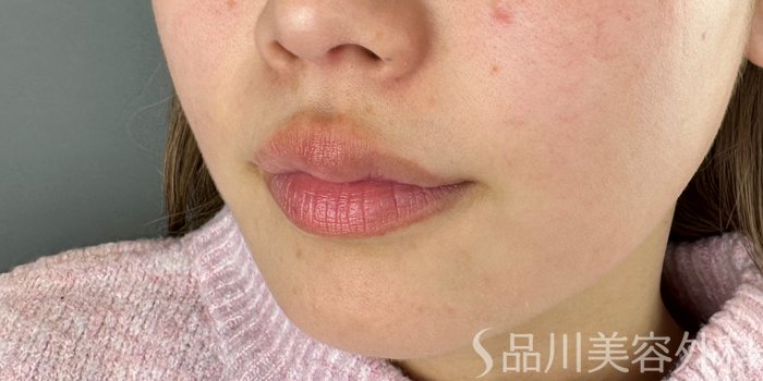 症例NO.70179のBEFORE写真