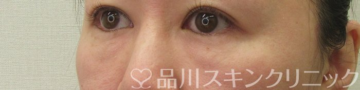 症例NO.71412のBEFORE写真