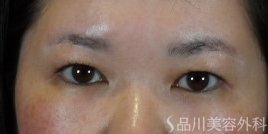 症例NO.74782のAFTER写真
