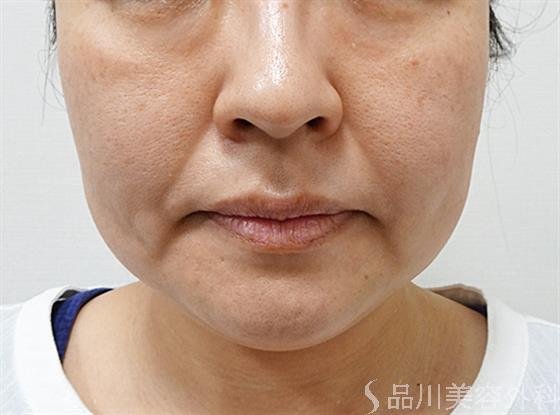 症例NO.55619のAFTER写真