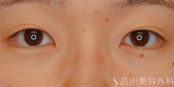 症例NO.59155のBEFORE写真