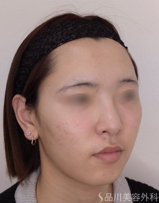 症例NO.68423のAFTER写真