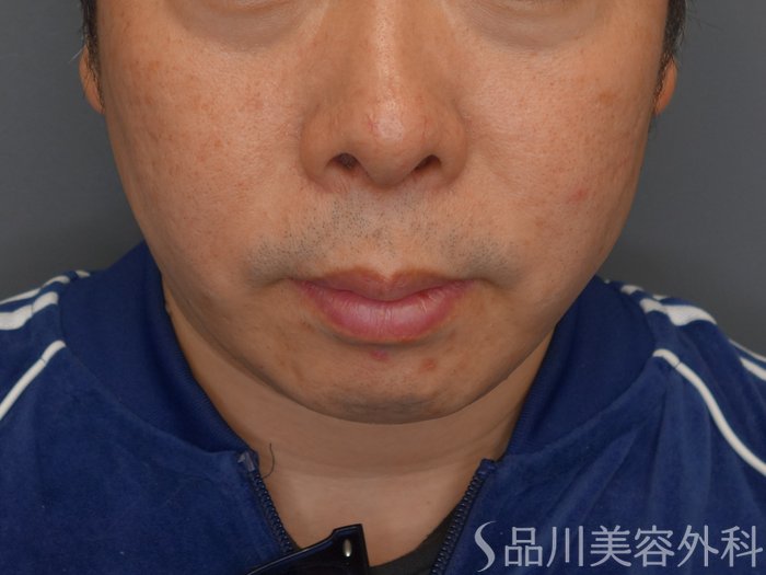 症例NO.75035のAFTER写真
