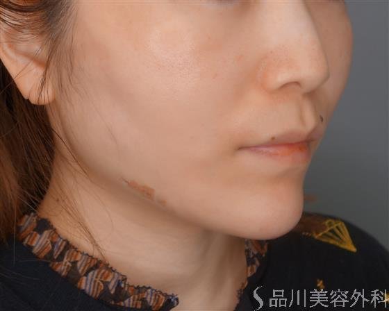 症例NO.53830のAFTER写真