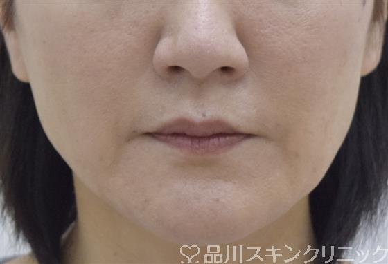 症例NO.53432のAFTER写真