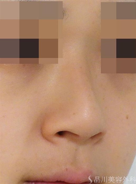 症例NO.44654のBEFORE写真