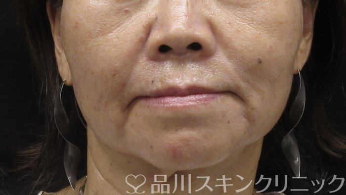 症例NO.73190のAFTER写真