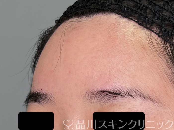 症例NO.70083のAFTER写真