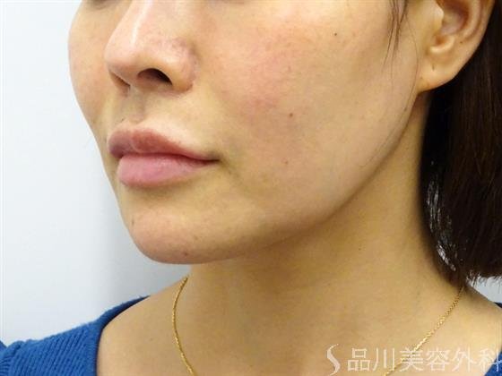 症例NO.52473のBEFORE写真