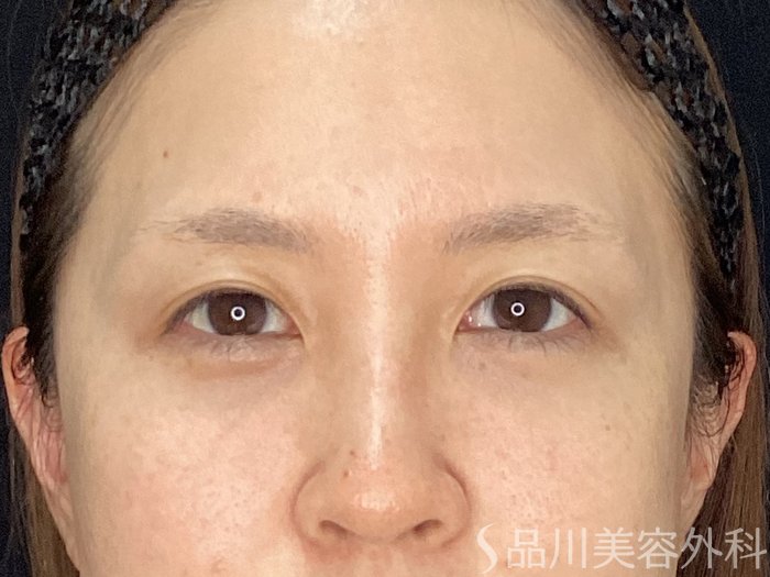 症例NO.71147のAFTER写真
