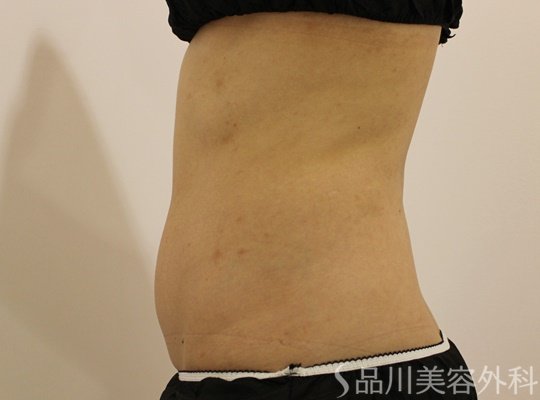 症例NO.73293のAFTER写真