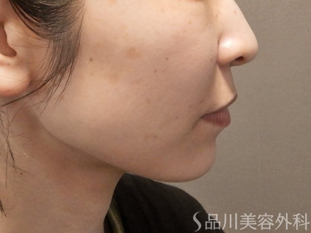 症例NO.74340のBEFORE写真