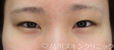 症例NO.70298のBEFORE写真