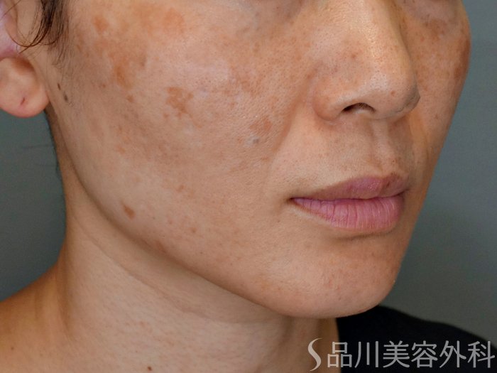症例NO.69173のBEFORE写真