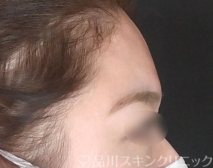 症例NO.68111のAFTER写真