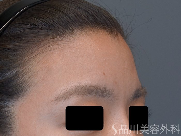 症例NO.75345のBEFORE写真