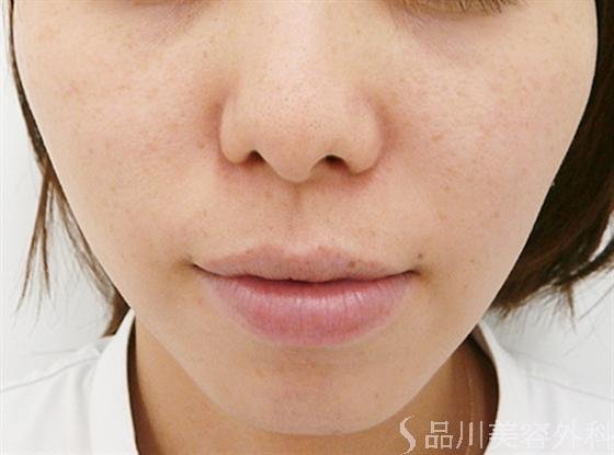 症例NO.14184のBEFORE写真