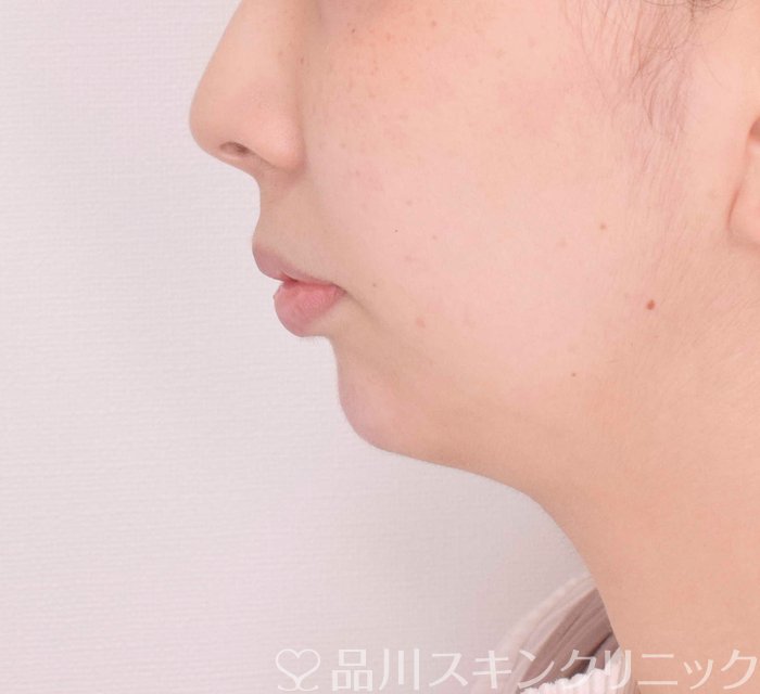 症例NO.69318のAFTER写真