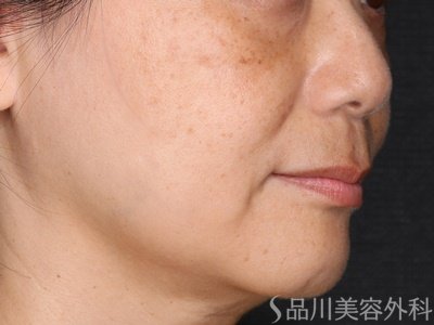 症例NO.75196のBEFORE写真